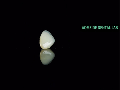 Keramische Kronenbrücke