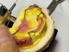 Maßgeschneiderte Kieferorthopädie mit guter Aufbewahrung und verstellbaren Eigenschaften