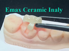 Das Emax Ceramic-Inlay, das genau für die vorgesehene Position maßgeschneidert ist