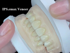 IPS.emax Veneer Premium ästhetische Lösung für atemberaubende Lächeln Transformationen