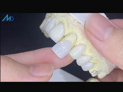 IPS Emax Veneers Minimal-Prep/No-Prep Veneers sind innovative Lösungen für ein schönes Lächeln