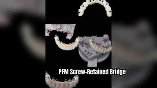 Präzisions-PFM-verschraubte Implantatrestauration