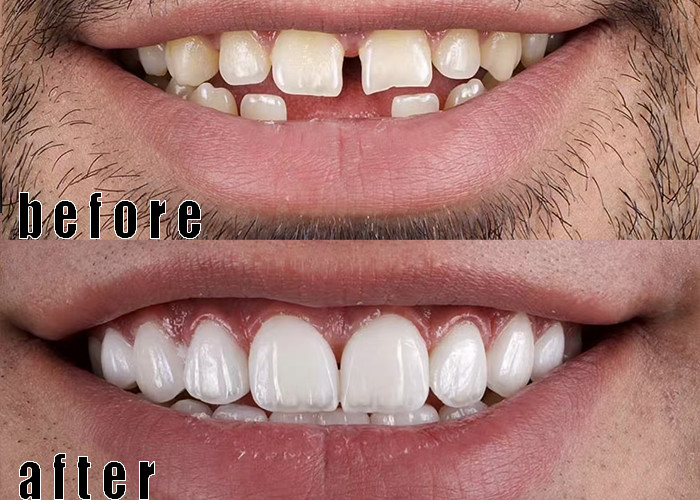Jüngste Firmenfälle über Porzellan Veneers Fall 3