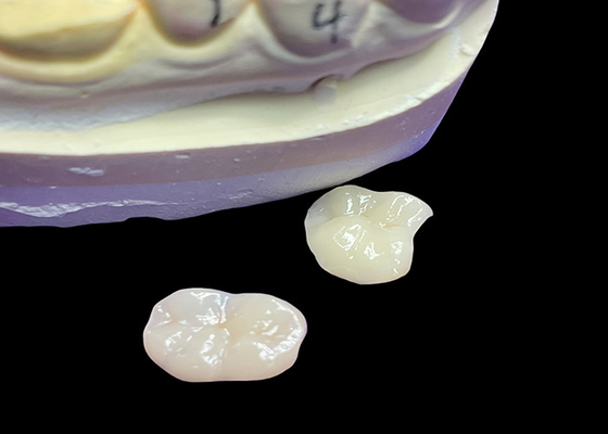 kaufen IPS e.max Keramik-Inlays und -Onlays zur Molarrestaurierung Natürliche Ästhetik und höhere Haltbarkeit für lang anhaltende Ergebnisse online manufacture