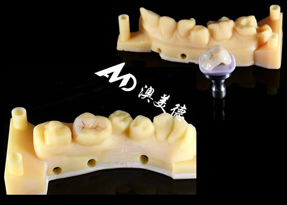 kaufen Glatte Hypoallergene Keramik-Inlays Onlays Custom Fit Fleckenbeständigkeit Hohe Haltbarkeit online manufacture