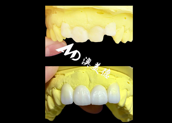kaufen Kundenspezifische durchsichtige Zirkonia Zahnkronen von AMD Dental Lab online manufacture