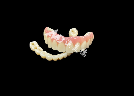 kaufen Implantatgestützte Zahnersatzbrücke Die ultimative Zahnlösung für fehlende Zähne online manufacture