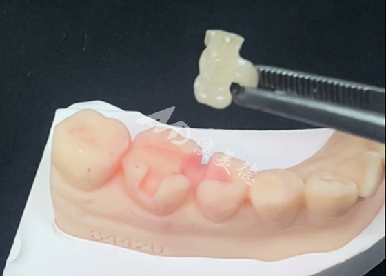 kaufen Emax Keramik-Inlays Onlays Zahnrestaurationen für natürliche Zahnfarbe und einfache Wartung online manufacture