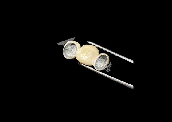 kaufen Präzise passendes Porzellan mit Metallkrone und ausgezeichneter Biokompatibilität online manufacture