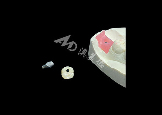 kaufen Zahnimplantatkronen revolutionieren die restaurative Zahnheilkunde online manufacture