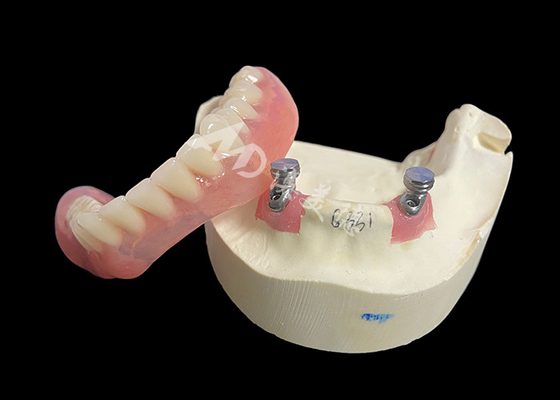 kaufen Implantat-Locator-Bar-Overdenture-Lösung für verbessertes Kauen und Sprechen online manufacture