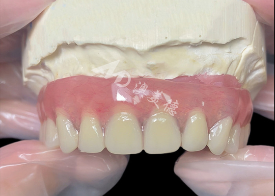 kaufen Titan-Implantat unterstützt Bar Anschluss Zahnersatz aus China Zahnlabor online manufacture