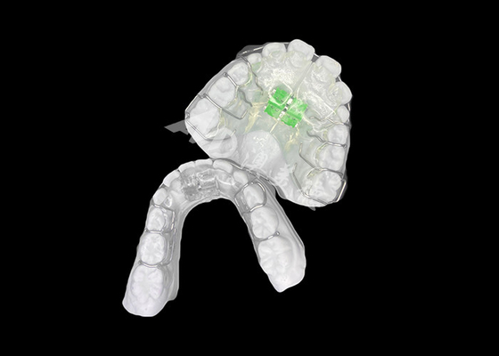 kaufen Effektiver, abnehmbare Kieferorthopädiexpanzer für eine optimale Ausrichtung des Kiefers und Zahngesundheit online manufacture
