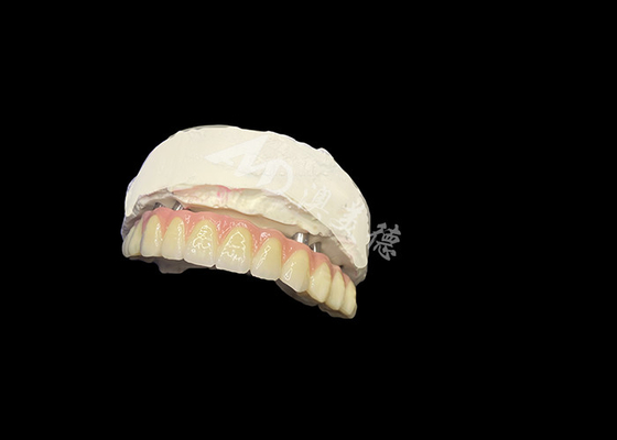 kaufen Implantatgestützte Zahnersatzstabilität Komfort und ein natürliches Lächeln online manufacture