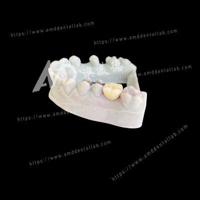 kaufen PFM Maryland Bridge One Pontic Two Wings A Conservative and Esthetic Solution online manufacture