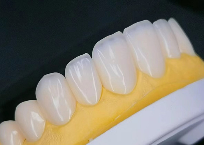 EMAX Porzellan Veneer mit Fleckenbeständigkeit für natürlich aussehende ästhetische Restaurationen