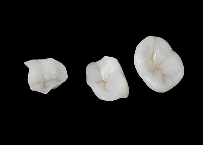 Biokompatible keramische Inlays und Onlays, die für eine komfortable Haltbarkeit und nahtlose Integration in natürliche Zähne konzipiert sind