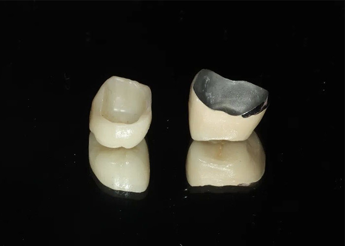 Hochfeste Restaurierung Porzellan mit Metallkrone für ein natürliches Lächeln