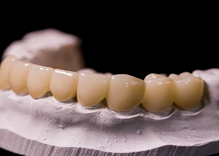 Porzellan, das mit Metallkronen verschmolzen ist - eine fortschrittliche Technologie zur langfristigen Wiederherstellung des Lächelns