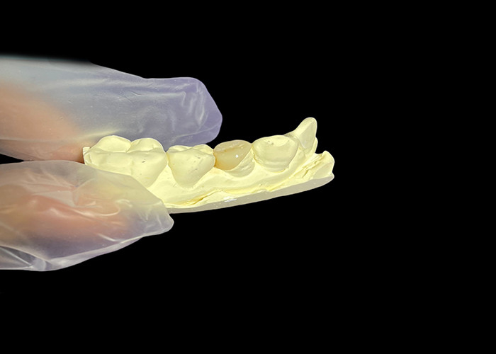 Keramisches Zahn-Inlay-Onlay zur effektiven Zahnreparatur mit langlebigen und ästhetischen Porzellanlösungen zur langfristigen Restaurierung