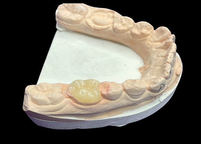 Custom Smooth Dental Ceramic Inlay für Färbungsbeständige nahtlose Zahnreparatur und natürliche Ästhetik