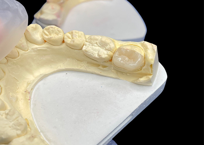 Custom Smooth Dental Ceramic Inlay für Färbungsbeständige nahtlose Zahnreparatur und natürliche Ästhetik