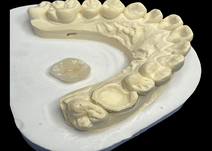 Keramisches Zahn-Inlay-Onlay zur effektiven Zahnreparatur mit langlebigen und ästhetischen Porzellanlösungen zur langfristigen Restaurierung