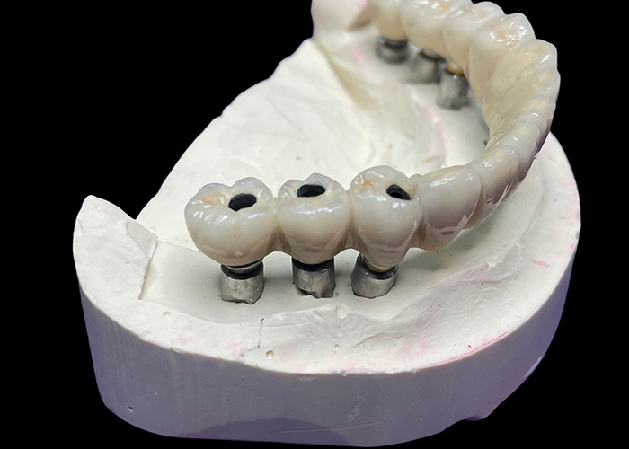 Das Zahnimplantat mit Titanium-Basis ist mit einer wunderschönen Keramik-Kronengröße überzogen, um eine perfekte Restauration zu schaffen.