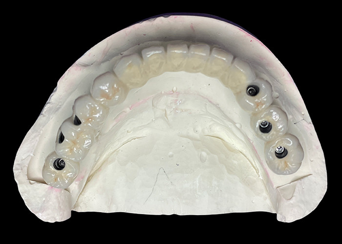 Das Zahnimplantat mit Titanium-Basis ist mit einer wunderschönen Keramik-Kronengröße überzogen, um eine perfekte Restauration zu schaffen.