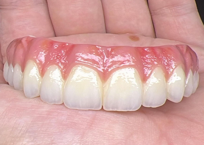 Oral Health Zahnimplantat Unterstützte Zahnprothesen Brücke Polierte Oberfläche Unterstützende vollständige Zahnprothesen