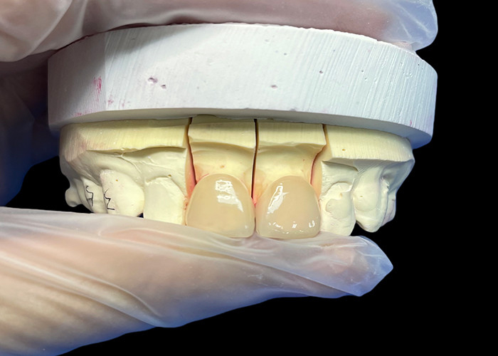 Präzisionsfestigkeit EMAX Porzellan Veneer Schneide für natürliche ästhetische Restaurationen