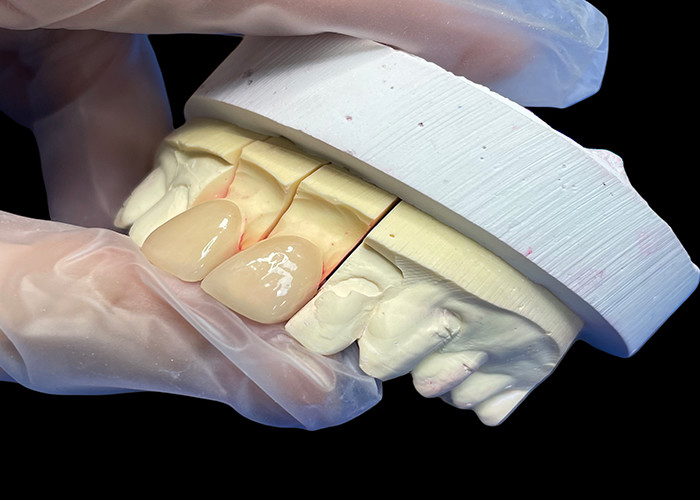 Präzisionsfestigkeit EMAX Porzellan Veneer Schneide für natürliche ästhetische Restaurationen