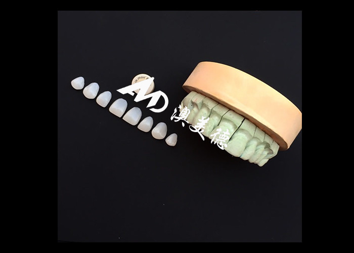 Transformieren Sie Ihr Lächeln mit IPS emax Press Porzellan Veneers Stärke Ästhetik und Haltbarkeit kombiniert
