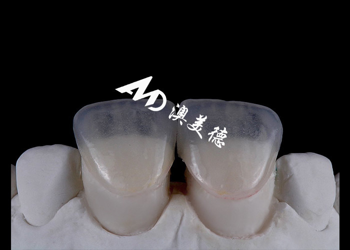 Transformieren Sie Ihr Lächeln mit IPS emax Press Porzellan Veneers Stärke Ästhetik und Haltbarkeit kombiniert