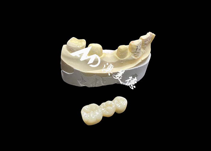 High-Hardness ästhetische Zirkonia Zahnkrone mit Durchsichtigkeit und Chipping Resistenz aus China Zahnlabor