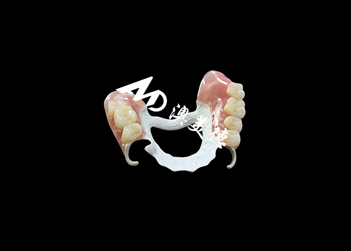 Abnehmbare Zahnprothese mit HPP-Rahmen und Acrylbasis für höhere Haltbarkeit und Komfort