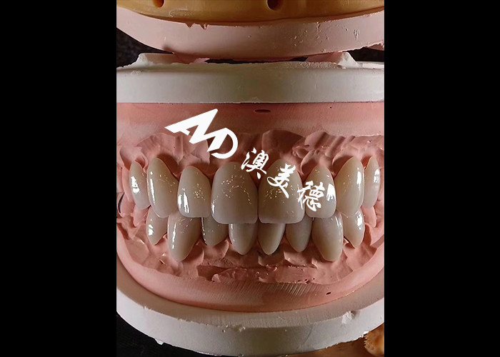 Kosmetische Zahnmedizin EMAX Zahnfineren 0,3-0,5 mm Dicke für ästhetische Restaurationen