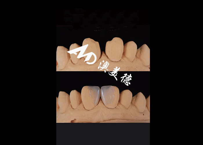 0.3-0.5mm Ultra dünne IPS EMAX Porzellan Veneers für ästhetische Lächeln Makeovers