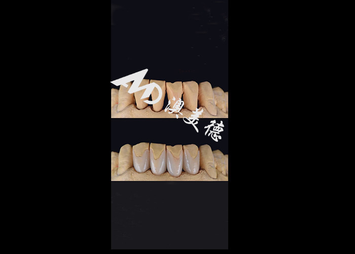 0.3-0.5mm Ultra dünne IPS EMAX Porzellan Veneers für ästhetische Lächeln Makeovers