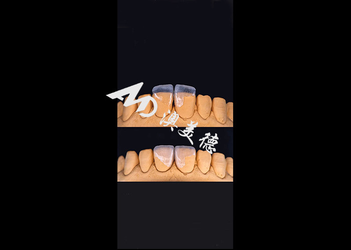 0.3-0.5mm Ultra dünne IPS EMAX Porzellan Veneers für ästhetische Lächeln Makeovers