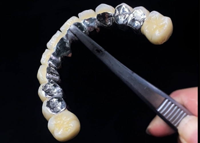 Porzellan, das mit Metallkrone verschmolzen ist und Dauerhaftigkeit und Schönheit für die Zahngesundheit verbindet