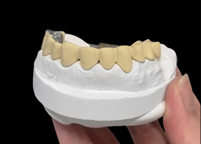 Porzellan, das mit Metallkrone verschmolzen ist und Dauerhaftigkeit und Schönheit für die Zahngesundheit verbindet