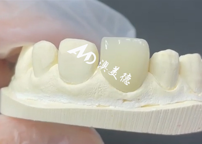 Dauerhafte und ästhetische EMAX-Fenerierung Die perfekte Lösung für Porzellan-Restaurationen