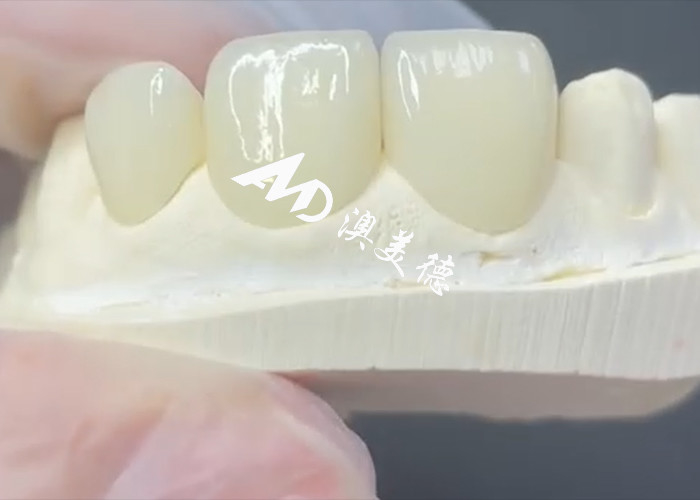 Dauerhafte und ästhetische EMAX-Fenerierung Die perfekte Lösung für Porzellan-Restaurationen
