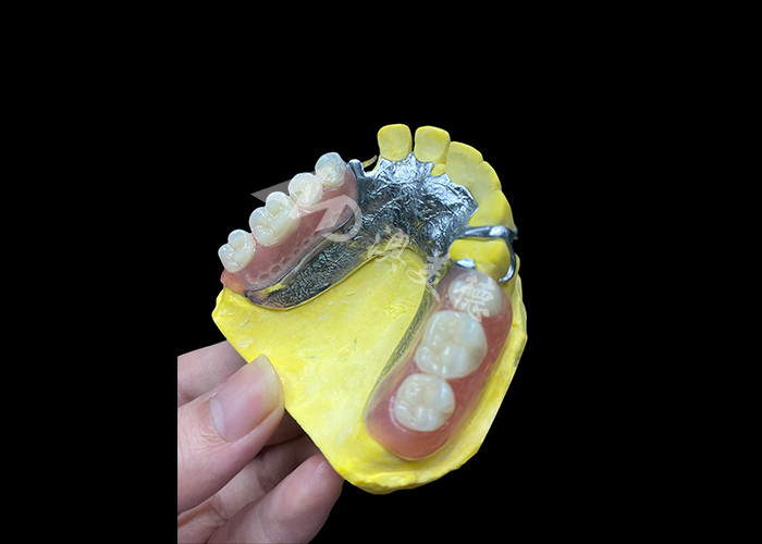 Verstellbare Guss-Teilzähne für mehr Komfort und Stabilität, perfekt zum Kauen und Sprechen