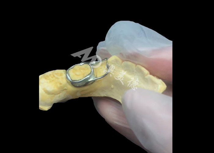 Orthodontic Space Maintainer ist ein unbezahlbares Gerät, das die Zahnlücke von Kindern geschickt schützt und eine ordnungsgemäße Zahnentwicklung gewährleistet.