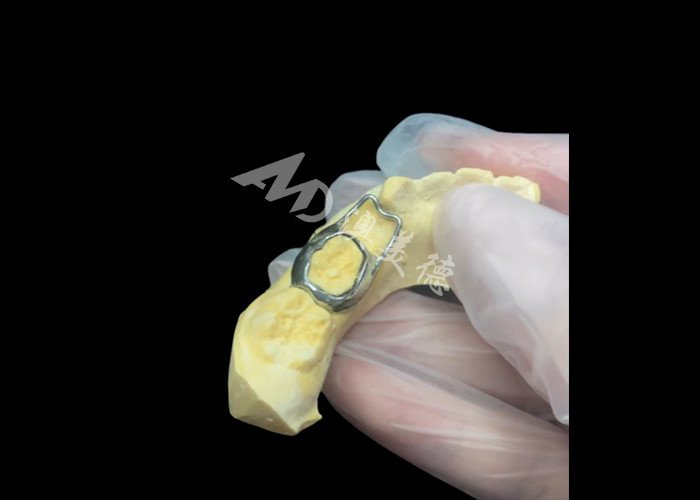 Orthodontic Space Maintainer ist ein unbezahlbares Gerät, das die Zahnlücke von Kindern geschickt schützt und eine ordnungsgemäße Zahnentwicklung gewährleistet.