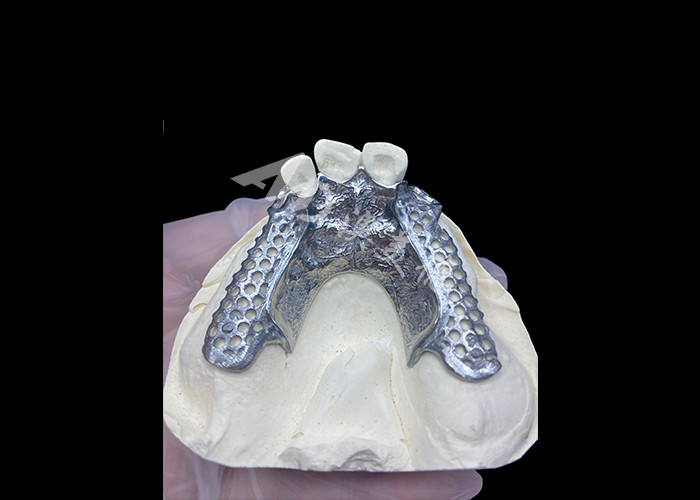 Einfache Anpassung Custom Cast Partial Denture Stabiler und natürlich aussehender Rahmen für schnelle Ergebnisse