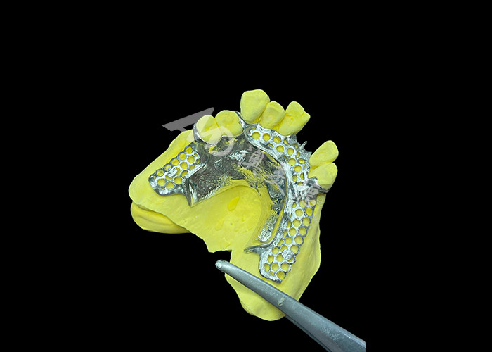 Custom Cast Partial Denture natürliche Lösung für mehr Komfort und Sprache