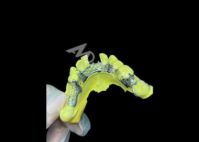 Custom Cast Partial Denture natürliche Lösung für mehr Komfort und Sprache